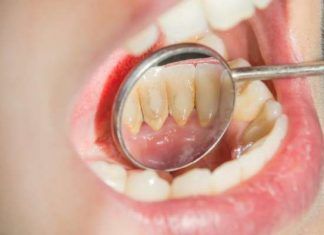 Mala higiene bucal propaga células cancerosas