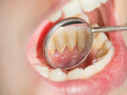 Mala higiene bucal propaga células cancerosas