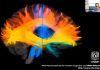 Infarto cerebral modifica conexiones neuronales