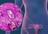 Cáncer cervicouterino