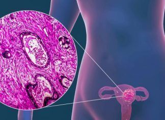 Cáncer cervicouterino