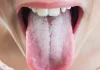 Artículo / ¡Cuidado con la lengua saburral!