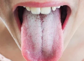 Artículo / ¡Cuidado con la lengua saburral!