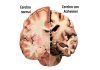 Grasas asociadas con Alzheimer