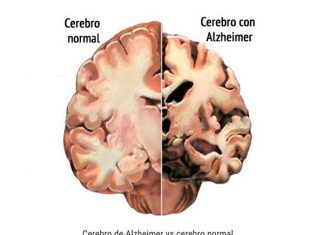 Grasas asociadas con Alzheimer