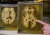 Nueva terapia abre la puerta a tratar la epilepsia