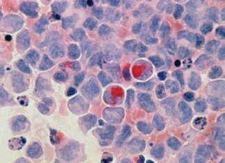 Aumento y envejecimiento de población mundial impulsarán tasa de muertes por cáncer