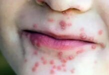 Brote de virus coxsackie provoca suspensión de clases en Tlapa de Comonfort