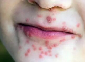 Brote de virus coxsackie provoca suspensión de clases en Tlapa de Comonfort