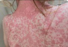 SSA lanzará campaña de vacunación en espacios públicos para contener brote de sarampión