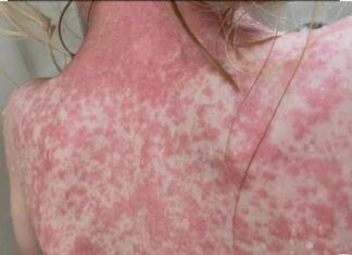 SSA lanzará campaña de vacunación en espacios públicos para contener brote de sarampión