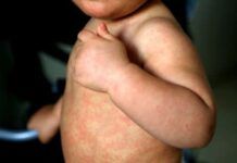 México superó los 10 mil casos de sarampión