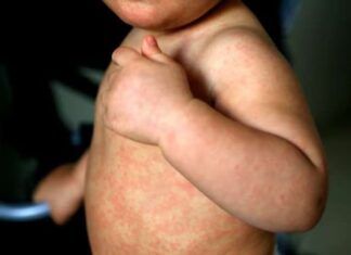 México superó los 10 mil casos de sarampión