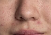 La marca invisible del acné: más que granos, una herida en la autoestima