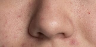 La marca invisible del acné: más que granos, una herida en la autoestima