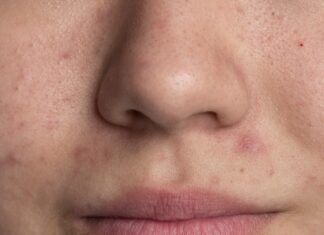 La marca invisible del acné: más que granos, una herida en la autoestima